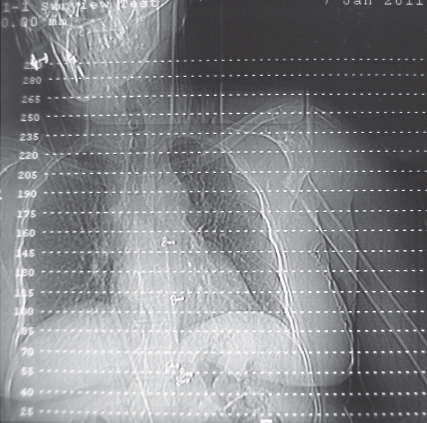 Xray showing bone resorption over the proximal humerus area.