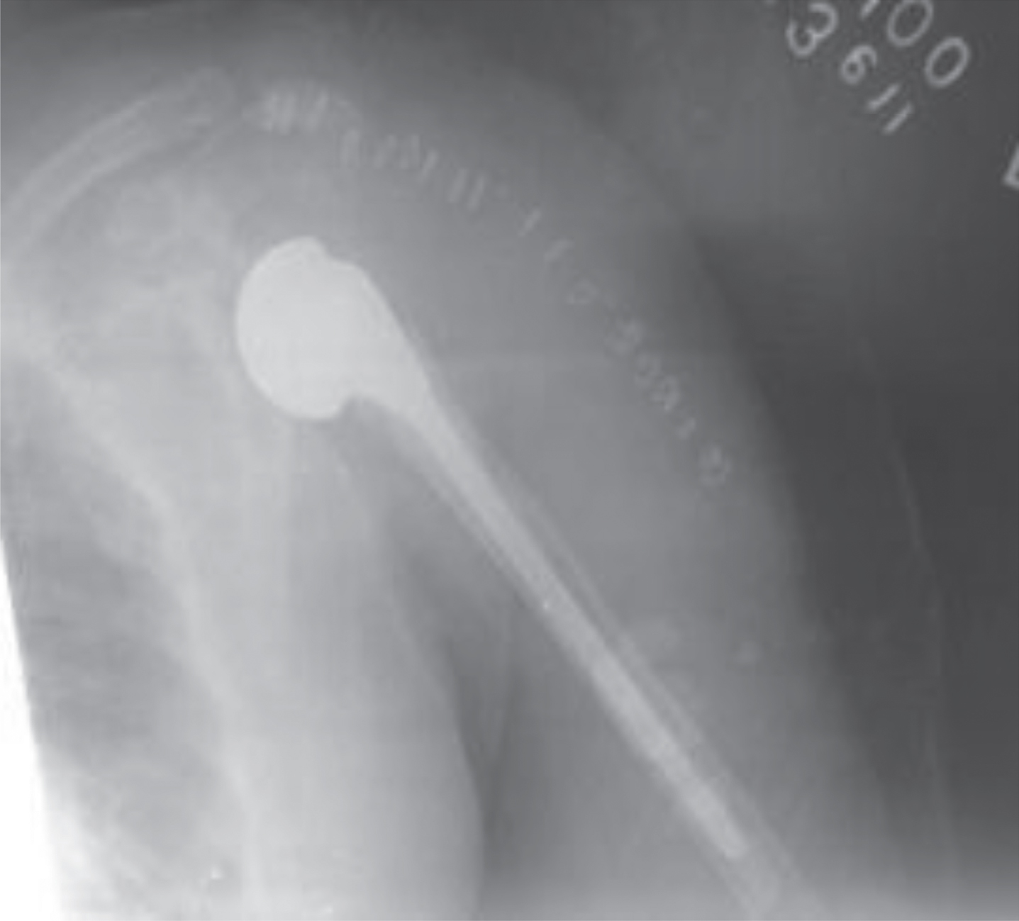 Post-op xray showing cemented proximal humerus prosthesis.