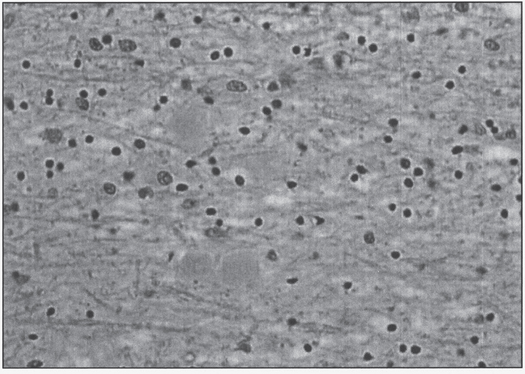 Neuroaxonal leukodystrophy. There are axonal spheroids in white matter associated with myelin degeneration.