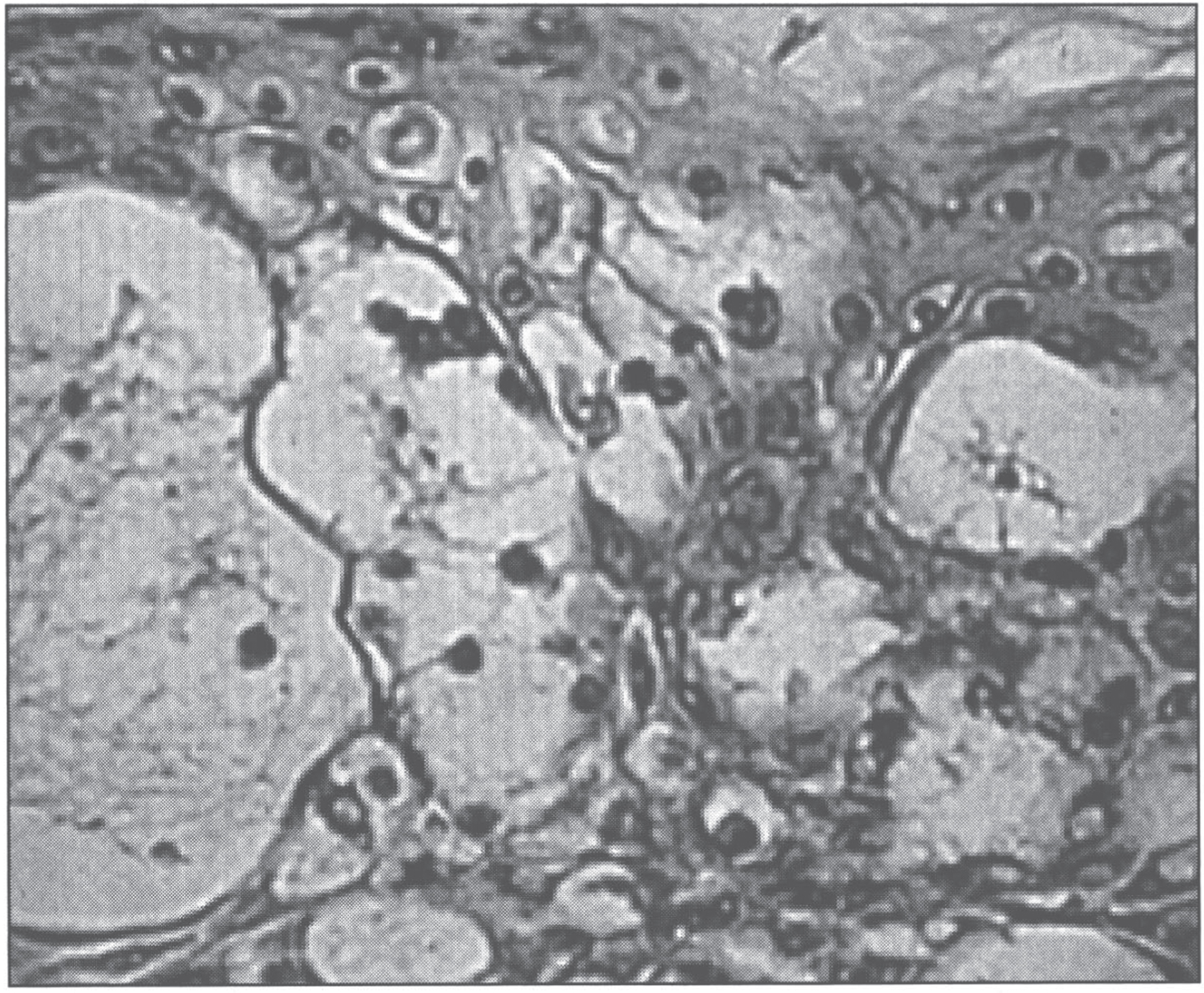 Microscopic appearance of skin in acrodermatitis enteropathica showing epidermal vacuolar degeneration.