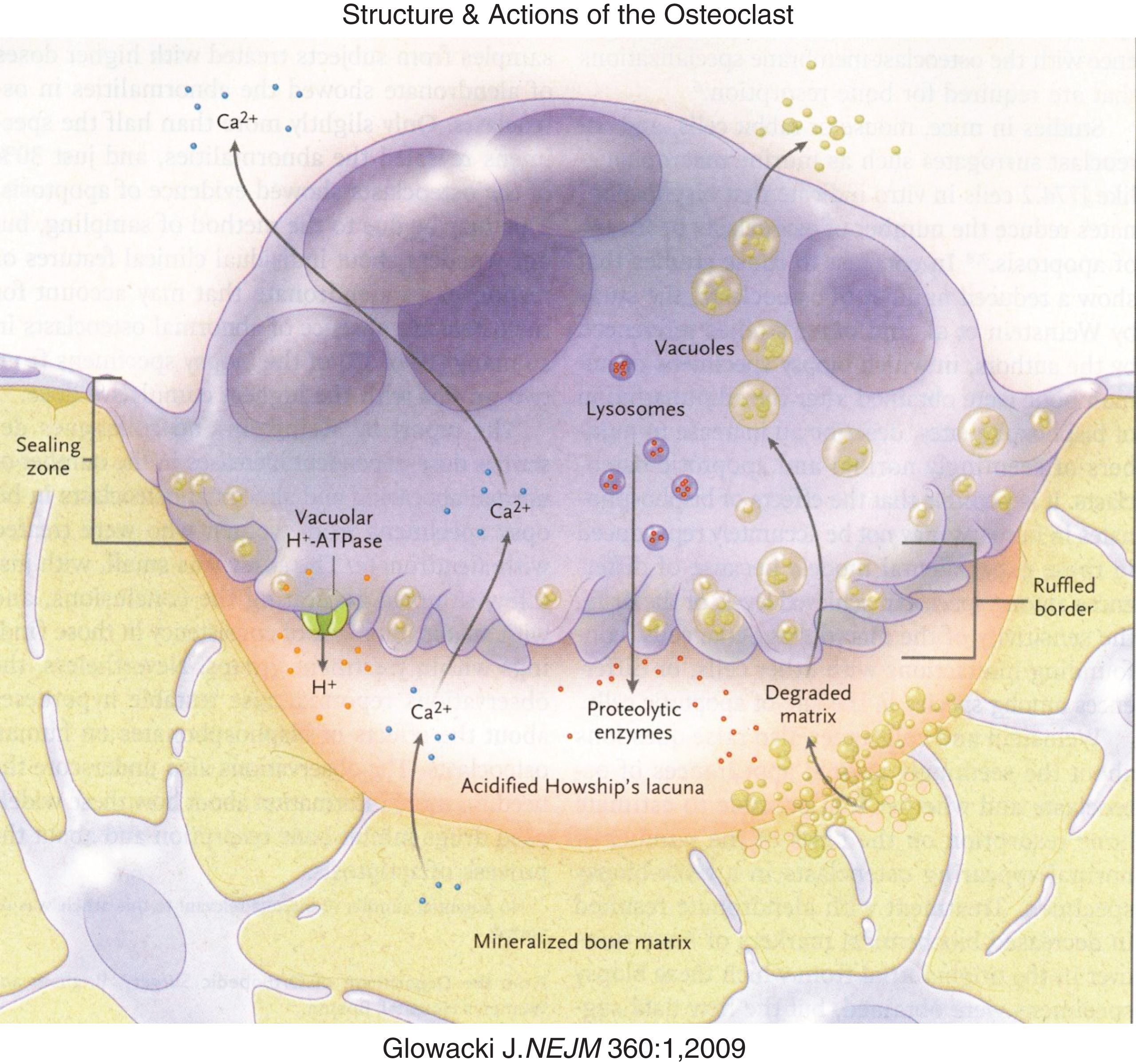 Diagrammatic representation of osteoclastic bone reabsorption depicting the osteoclast adherent to bone, subosteoclastic lacuna, secretion of acid and proteolytic enzymes into the lacuna and transport of digested products of reabsorption through the osteoclast. (Reproduced with permission from Glowacki J The deceiving appearances of osteoclasts. N Engl J. Med 360:80-82,2009.)