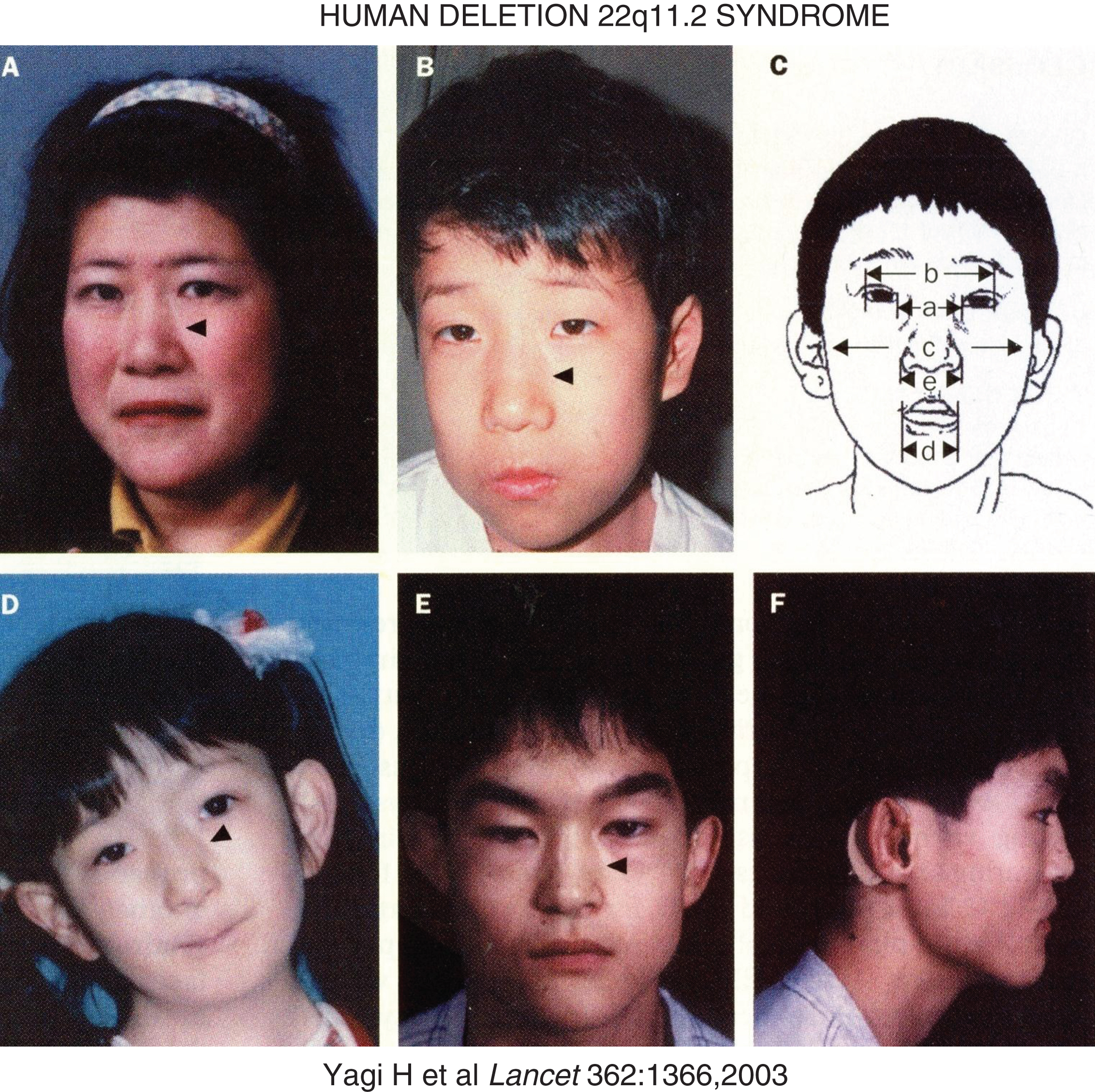 Facial characteristics of the deletion chromosome 22.q11 syndrome and/or mutations in TBX1. Panels A and B are mother and son – arrowheads point to the divide into upper and lower segments. Panel C schematically depicts a – ocular hypertelorism; b – short palpebral fissures; d – small mouth (a – inner canthal distance; b – outer canthal distance; c – transverse facial width; d – oral width; e – nasal width). Panel D depicts the face of a patient with conotruncal anomaly face syndrome, intact chromosome 22q11, mutation in TBX1. Panels E and F display frontal and lateral views of a patient with the DiGeorge syndrome, intact chromosome 22q11, and mutation in TBX1. (Reproduced with permission from Yagi H, Furutani Y, Hamada H, et al. Role of TBX1 in human del22q11.2 syndrome. Lancet 362:1366-1373,2003.)