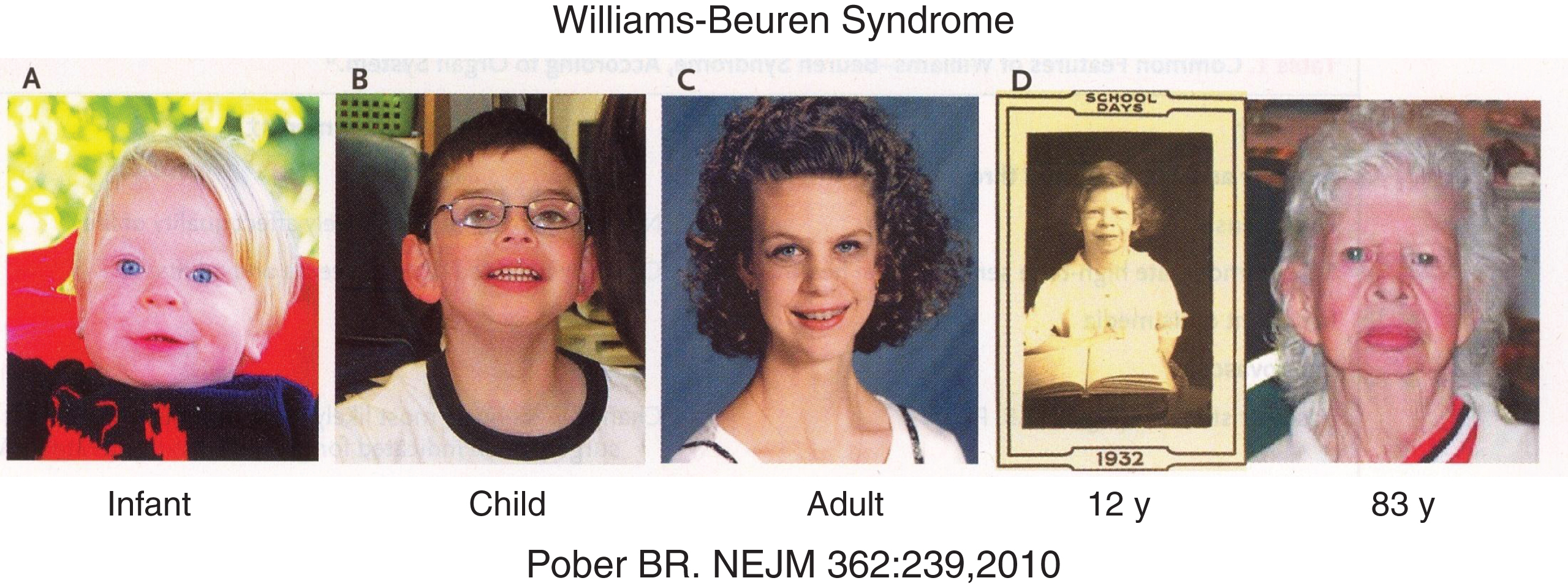 Facial characteristics (pixie-like face with flat nasal bridge, upturned nose, full lips) of a patient with the Williams-Beuren syndrome from infancy to elderly. (Reproduced with permission from Pober BR. Williams-Beuren syndrome. N Engl J Med 362:239-252,2010.)