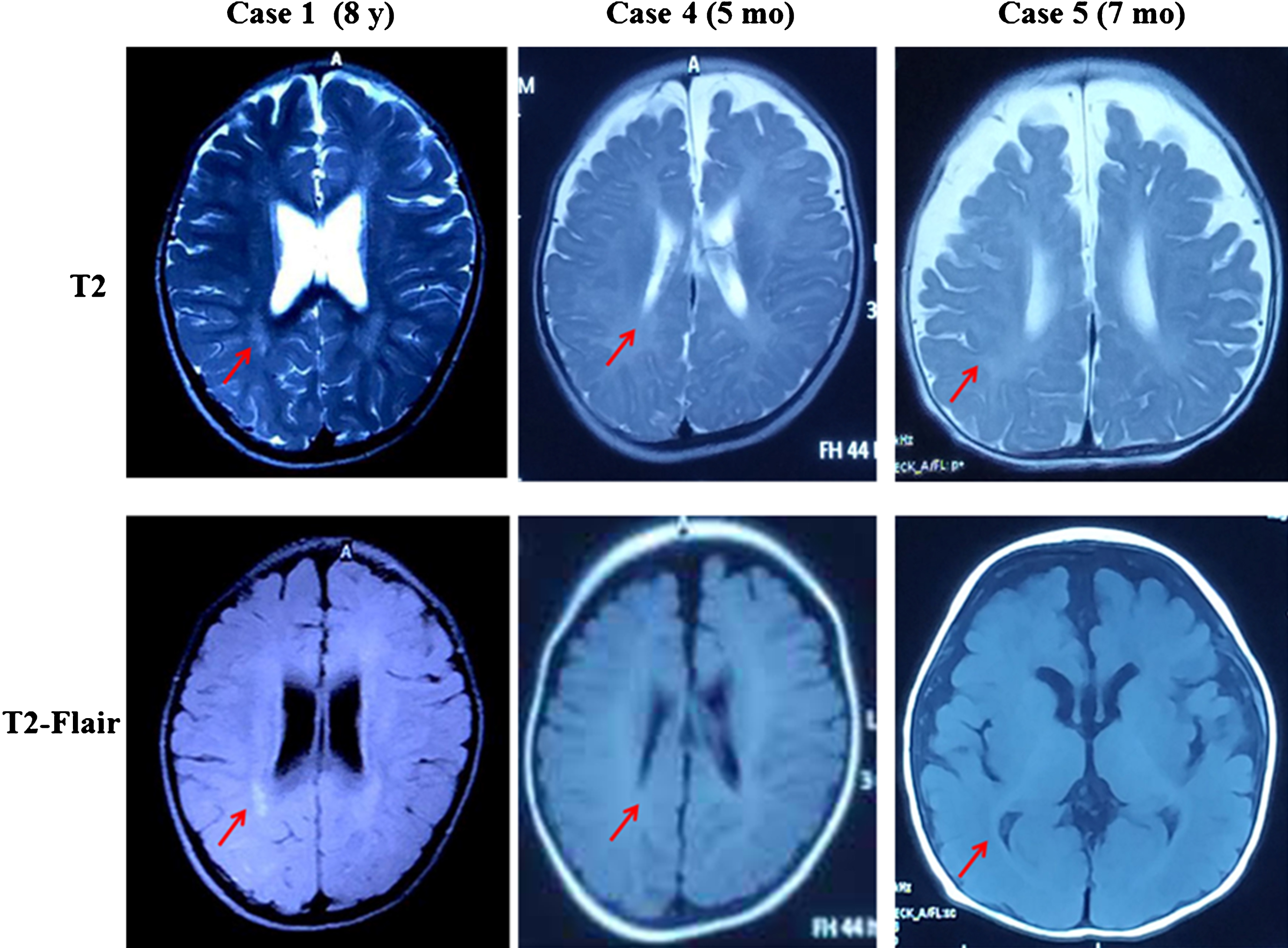 MRI of Case 1, 4 and 5. The red arrow points to delayed myelination of white matter.