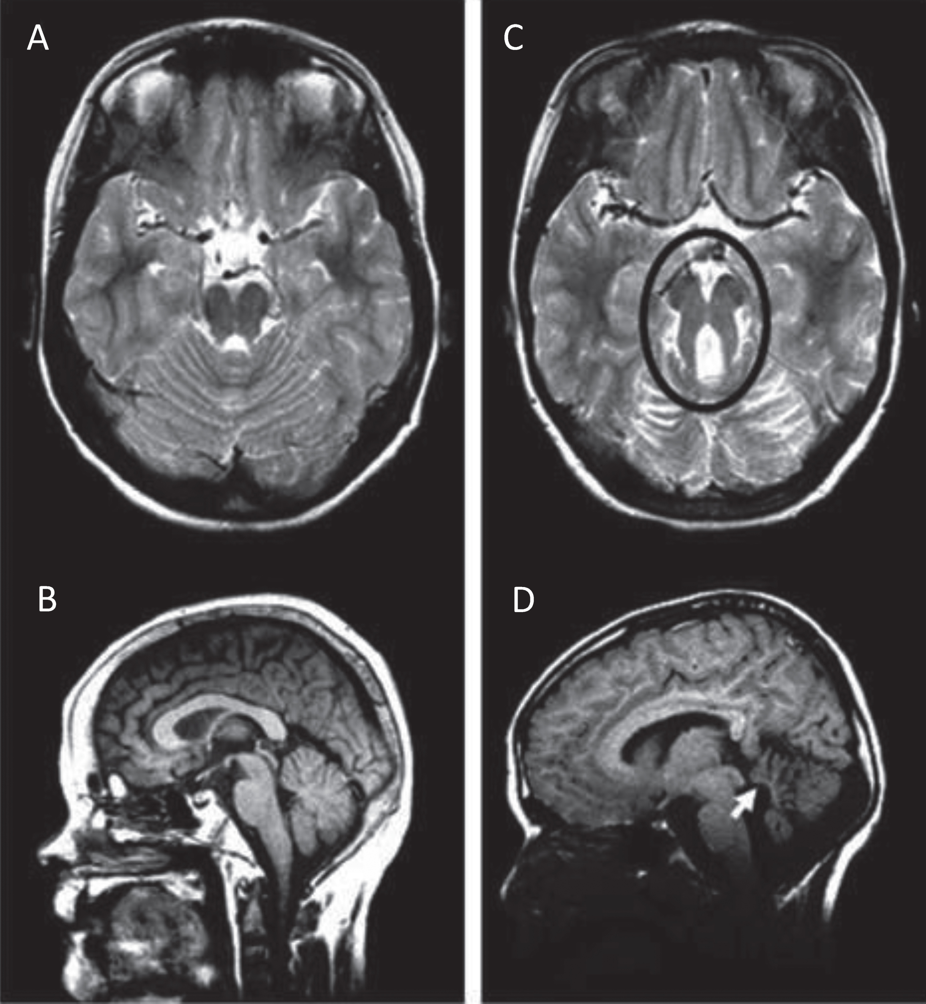 Molar Tooth Sign in Joubert syndrome. T2-weighted MRI images on axial view (A) and mid-sagittal view (B) through the cerebellum and brainstem of a normal individual showing intact cerebellar vermis. T2-weighted MRI image on axial view (C) and mid-sagittal view (D) through the cerebellum and brainstem of a child with JS. The Molar Tooth Sign is circled in black, with rostral shifting or elevation of the roof (fastigium) of the fourth ventricle and vermis hypoplasia (white arrow).