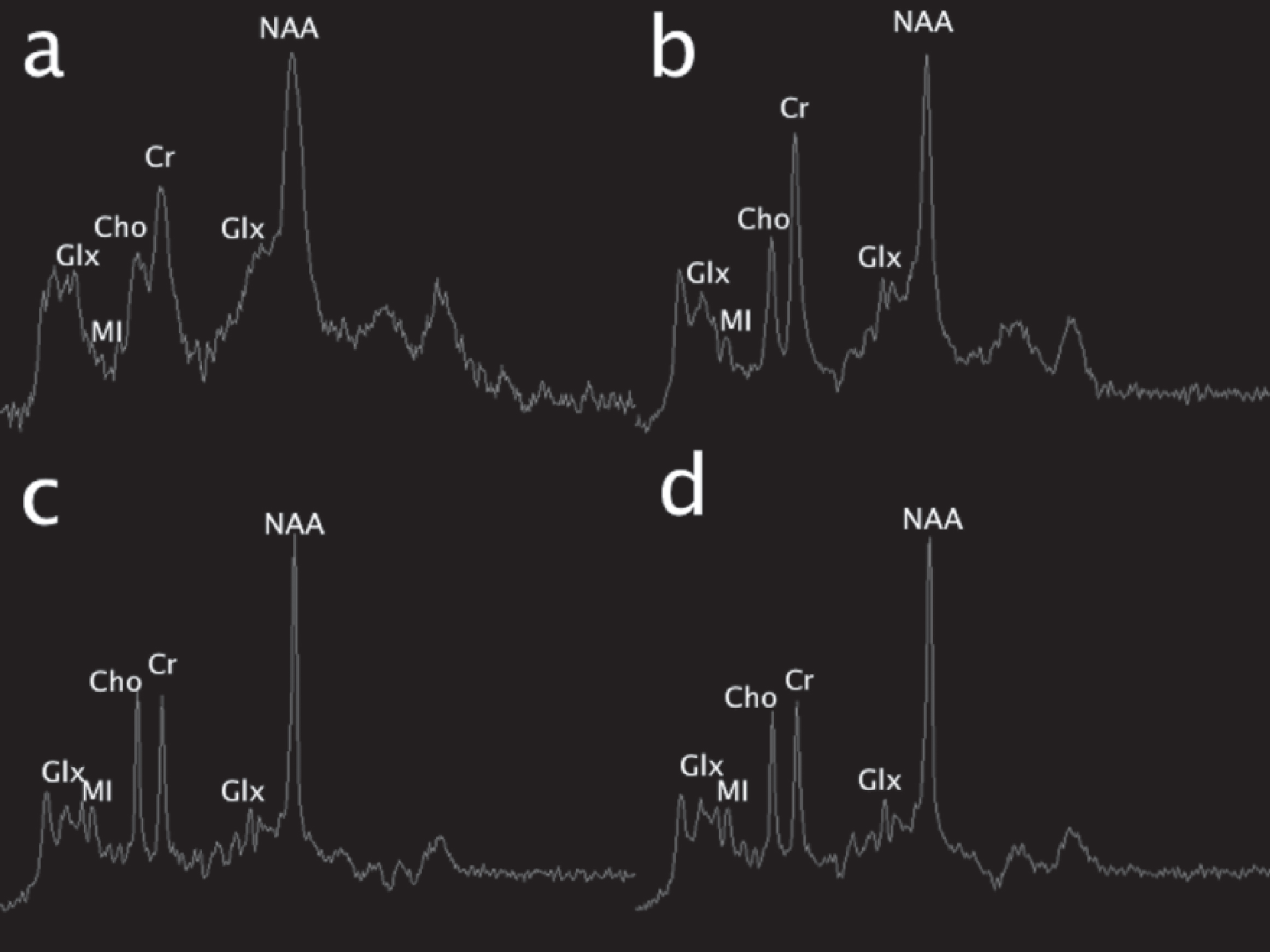 Single voxel MR spectroscopy (MRS) (TR/TE msec, 1500/35). Initial exam (a; left basal ganglia voxel) shows an elevated glutamine and glutamate peak complex at 2–2.5 ppm and 3.8 ppm (Glx) and reduction of myoinositol (MI). 19 days later, similar changes were present in the same area (b), though subtle differences cannot be discerned due to ferromagnetic artifact on the first study. On the pentultimate MRS performed 3 months later, no significant glutamine or glutamate elevation was present in the left parietal white matter; however, myoinositol was mildly depressed. On the final MRS performed at 6-month follow-up over the left basal ganglia, similar changes are noted; glutamine remains well-controlled and myoinositol and choline (Cho) were mildly depressed.