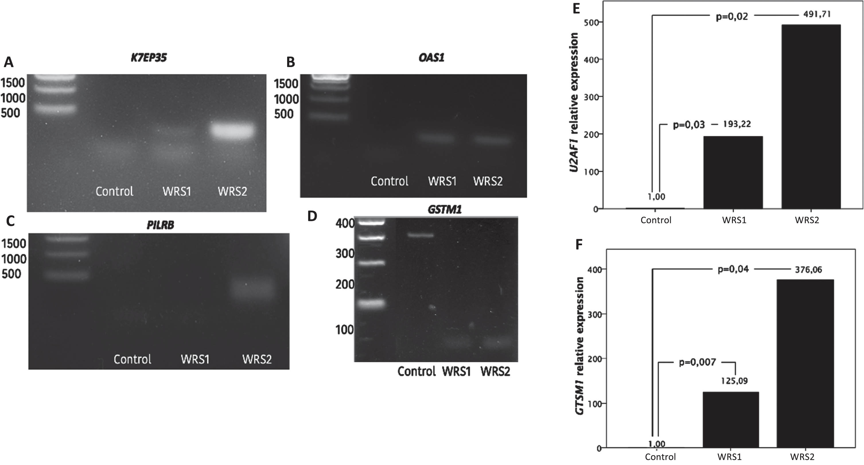 Intron retention analysis by PCR and agarose electrophoresis and mRNA relative expression of U2AF1 and GSTM1 in control and WRS cells. A) Migration pattern of the PCR products of the K7EP35 gene. Molecular weight marker in the first lane, one single band with a molecular weight of 320 bp in the second lane that corresponds to the expression of the transcript without intron retention in the control cells and the PCR products of the WRS1 and WRS2 cells in the third and fourth lane, respectively, with two bands observed, the smaller one corresponding to the amplicon without the retained intron and with a molecular weight of 320 bp, and the larger one corresponding to the amplicon with the retained intron and with a molecular weight of 499 bp. B) Migration pattern in agarose gel electrophoresis of the PCR products of the OAS1 gene. The molecular weight marker in the first lane, the PCR products of the control cells with no bands observed in the second lane, and one band of 498 pb observed in the third (WRS1) and fourth (WRS2) lane that corresponds to an OAS1 intron. C) Migration pattern on agarose gel electrophoresis of the PCR products of the PILRB gene. The molecular weight marker in the first lane. No band was observed in the second and third lane (control cells and WRS1 cells), which refers to the fact that there was no retention of any intron, and a band of 432 bp in the fourth lane, which corresponds to the amplicon with the retained intron of PILRB in WRS2 cells. D) Migration pattern in agarose gel electrophoresis of the PCR products of the GSTM1 gene. The molecular weight marker in the first lane. One single band of 303 bp observed in the second lane, that corresponds to GSTM1 with intron retention in control cells. And a single band of 96 bp in the third (WRS1) and the fourth (WRS2) lane, which refers to the GSTM1 amplicon without the retained intron. E) Relative expression of U2AF1 and E) GSTM1 normalized to GAPDH expression, showing and increased expression in WRS cells compared to control cells, with a greater difference in WRS2 cells.