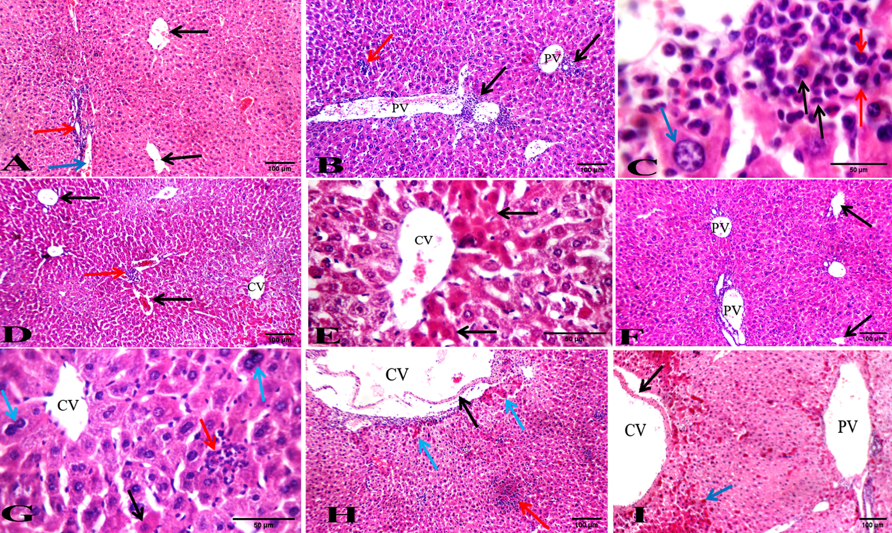 Photos of liver sections stained with hematoxylin and eosin. (A) Normal healthy group showing average CV (black arrows) with average PT showing average BD (red arrow) and average PV (blue arrow) (H&E x200). (B) DMBA-treated group showing dilated PV with marked leukemic infiltrate in PT (black arrows) and in blood sinusoids (red arrow) (H&E x200). (C) DMBA-treated group showing markedly pleomorphic leukemic cells (black arrows) with large nuclei and prominent eosinophilic nucleoli (red arrows), and preserved hepatocytes in the interface area (blue arrow) (H&E x1000). (D) BFB -treated 1/10 group showing average CV and mildly dilated PV (black arrows) with mild leukemic infiltrate in PT (red arrow) (H&E x200). (E) BFB -treated 1/10 group showing dilated CV with markedly apoptotic hepatocytes in perivenular area (black arrows) (H&E x400). (F) BFB -treated 1/5 group showing CV (black arrow) and mildly dilated PV (H&E x200). (G) BFB -treated 1/5 group showing average CV with scattered apoptotic (black arrow) and bi-nucleated hepatocytes (blue arrow) with mild leukemic infiltrate (red arrow) (H&E x400). (H) BFB control 1/10 group showing dilated CV with detached lining (black arrow) and mildly apoptotic hepatocytes in peri-venular area (blue arrow) with intra-parenchymal inflammatory infiltrate (red arrow) (H&E x200). (I) BFB control 1/5 group showing dilated CV with detached lining (black arrow) and dilated PV with apoptotic hepatocytes more marked in peri-venular area (blue arrow) (H&E x200).