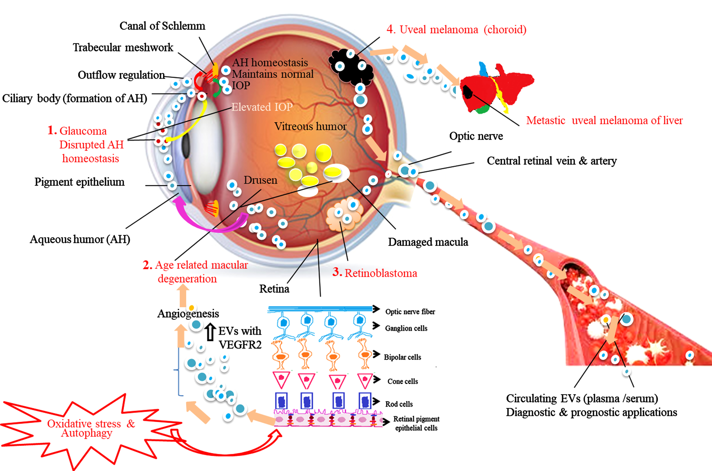 Schematic representation of the role of exosomes in aqueous humor (AH) homeostasis under normal and disease conditions. Red arrows show the movement of exosomes from the ciliary body (CB -site of AH production) to trabecular meshwork (TM). The green arrow show the movement of exosomes from TM to CB. Based on the available literature, we speculate that exosomes control AH outflow and inflow regulation, maintain AH equilibrium and normal intraocular pressure (IOP). 1. Glaucoma: Myocilin-derived EVs (red circles) released from CB (yellow arrow) diffuse into the AH causing disrupted AH homeostasis blocking TM resulting in elevated IOP leads to impaired vision. 2. Age-related macular degeneration (AMD): In response to oxidative stress and autophagy retinal pigment epithelial (RPE) cells, the outer layer of retina cells release higher concentration of exosomes having elevated expression of VEGFR2 into the anterior chamber (pink arrow) induces new blood vessels formation and drusen leads to AMD condition. 3. Retinoblastoma (RB): Exosomes released from RB tumors enter into the systemic circulation. 4. Uveal melanoma (UM): Exosomes released from primary UM involve tumor invasion, migration, and formation of metastatic niche in liver, the most common metastatic site for UM. Exosomes and their molecular content released into the systemic circulation during the above disease conditions serve as disease signature markers and possess diverse diagnostic and prognostic potential.