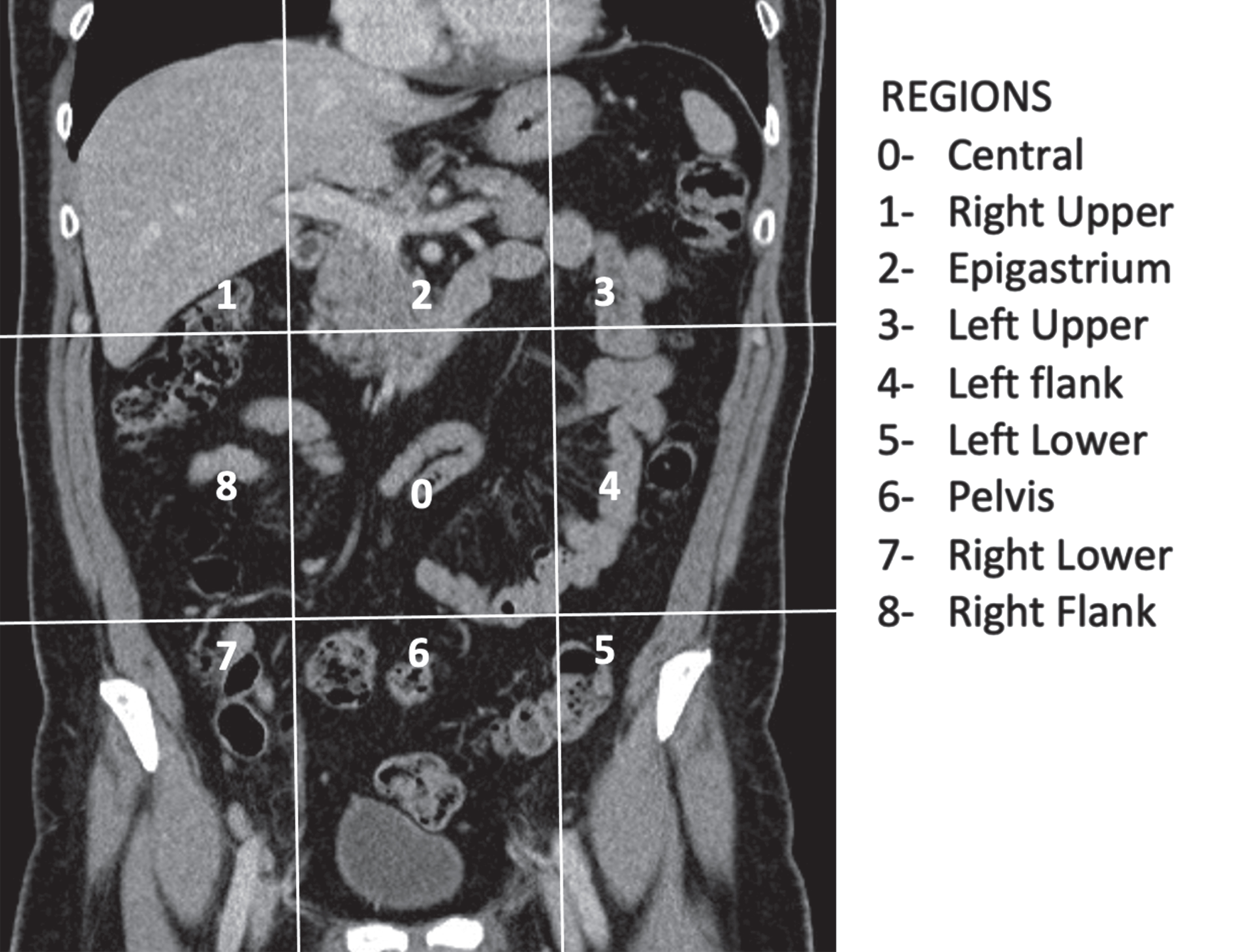 PCI score dived and renamed the abdomen in nine regions by two transverse planes and two sagittal planes. Nine regions are numbered in clockwise direction with 0 at the umbilicus and 1 defining the space beneath the right hemidiaphragm.