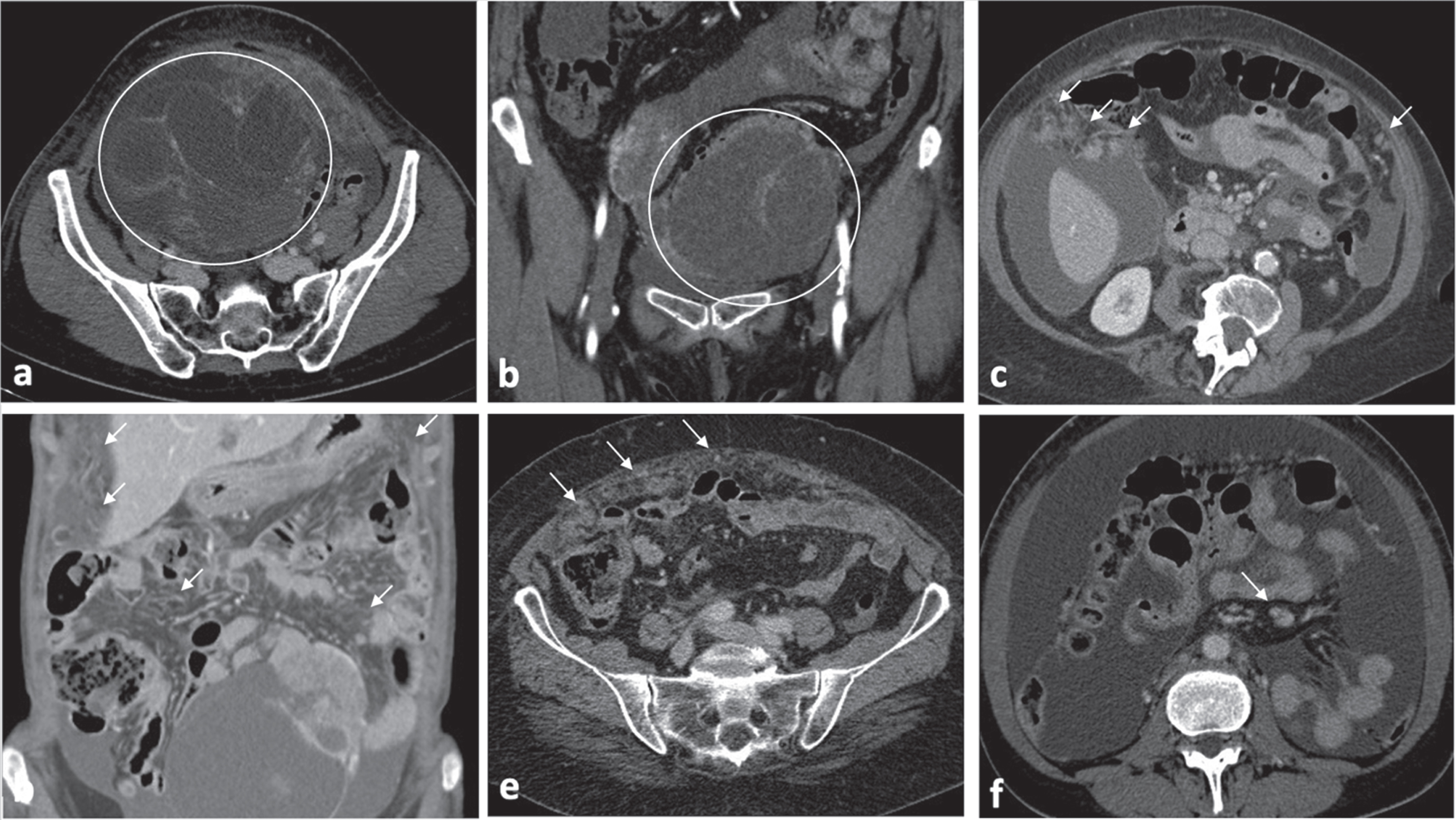 BRCA WT OC typical features consist in: ovarian masses with cystic/predominantly cystic structures (Fig. 3a-b); micronodular carcinomatosis and macronodular carcinomatosis with infiltrative morphologic pattern characterized by mostly poorly defined borders (Fig. 3c-e); presence of mesenteric lymphadenopathy (short-axis greater than 1 cm) (Fig. 3f).