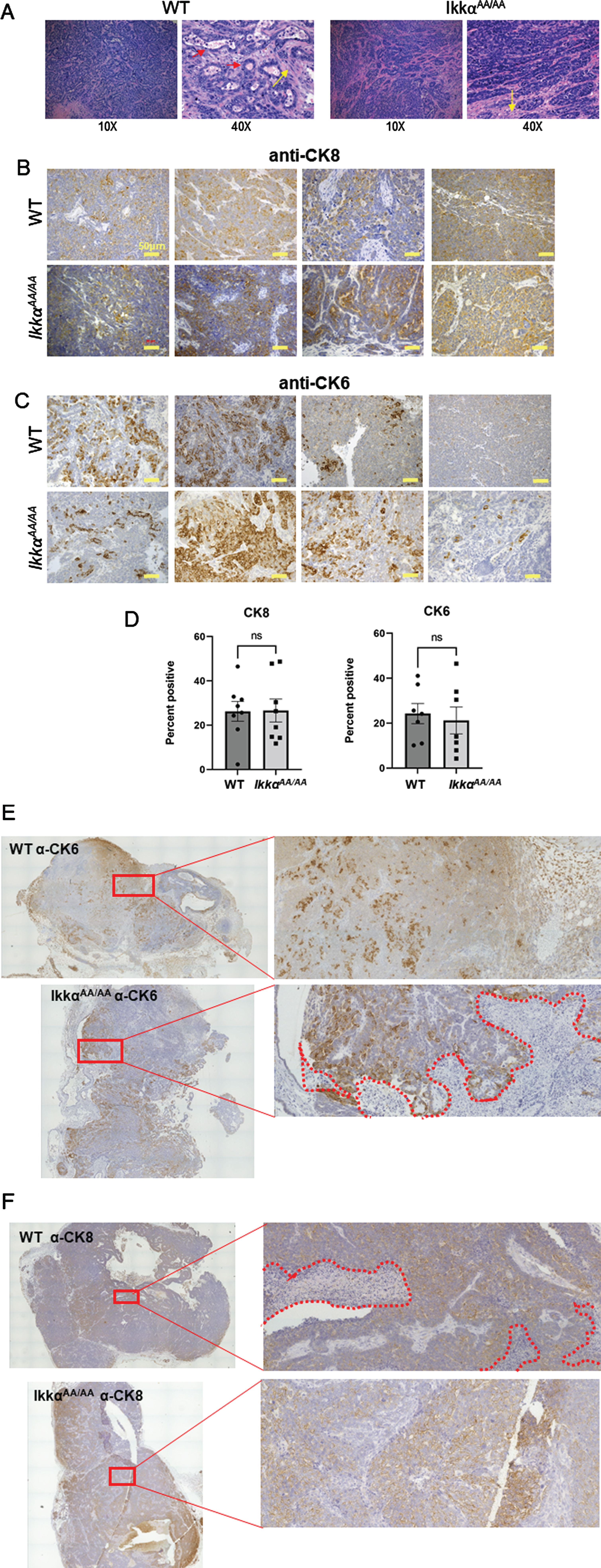 Histopathology of C3(1)-TAg tumors from WT and IkkαAA/AA mice. A, Examples of H&E sections from different IkkαAA/AA and WT mice showing typical solid adenocarcinomas with varying regions of squamous (metaplastic) differentiation (yellow arrows). Some tumors had tumor surrounding residual lobular and ductal structures (red arrows). Image magnification is shown below. B, Tumor sections from the indicated mouse genotypes were immunostained with anti-CK8 (luminal cytokeratin) and C, anti-CK6 (basal cytokeratin) as described in Methods. Bars are 50μm. D, Full tumor immunohistochemistry sections were scanned on an EVOS FL Auto 2 microscope and analyzed using FIJI for expression of CK8 (n = 8 WT and n = 9 IkkαAA/AA tumors) and CK6 (n = 7 WT and IkkαAA/AA tumors). Representative C(3)1-TAg whole tumor scans from WT and IkkαAA/AA mice are shown immunostained with CK6, E and CK8, F (20X objective). Boxed regions are expanded on the right. Necrotic areas are outlined by dotted lines.