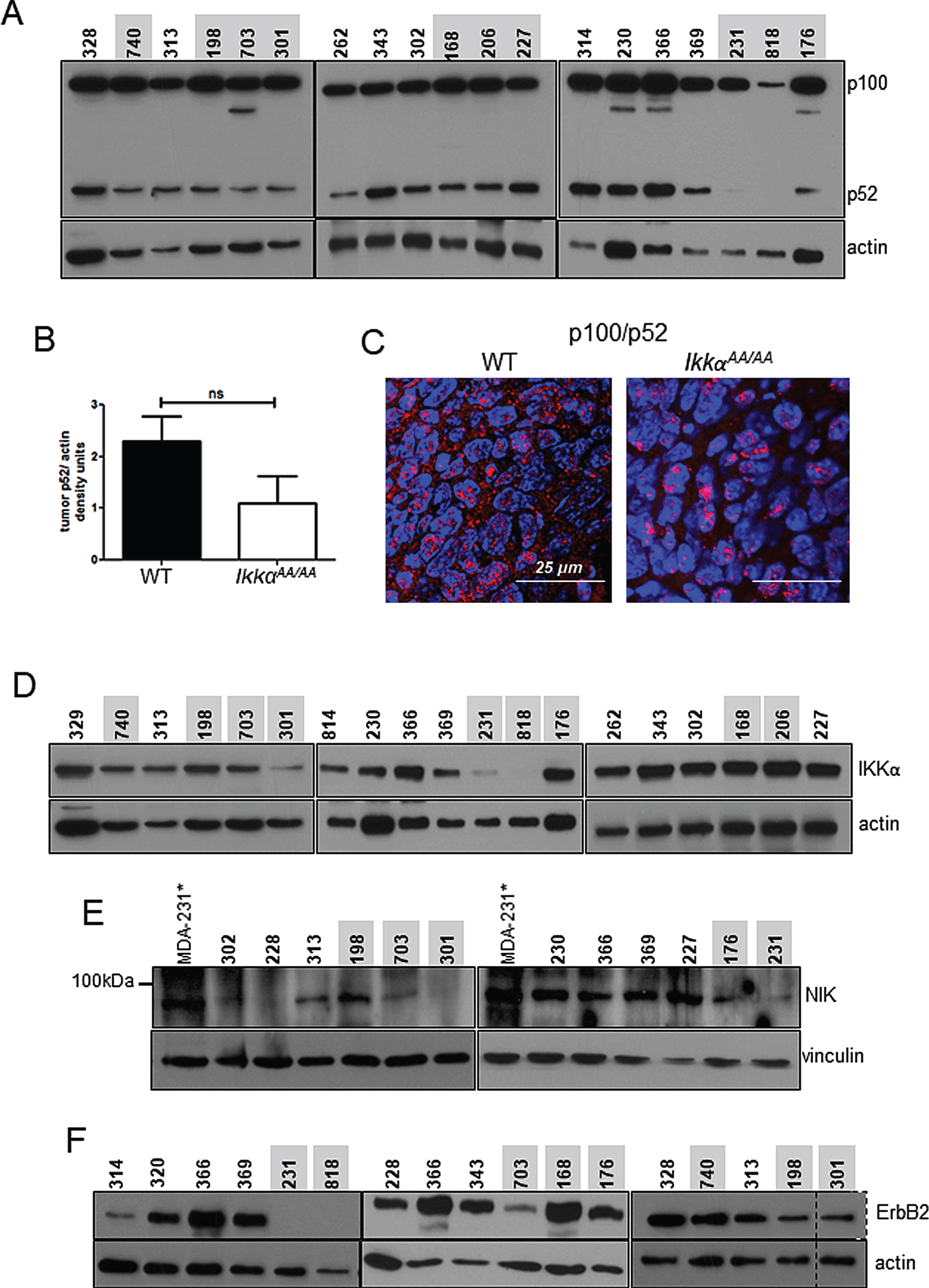 WT and IkkαAA/AA C3(1)-TAg tumors contain p100 and processed/nuclear p52: A, Immunoblot to detect p100/p52 in WT and IkkαAA/AA tumors. Actin was used as a loading control.Mouse identification numbers are shown above each sample and were used to track tumor genotype and protein samples (WT tumors are indicated in black and IkkαAA/AA tumors are indicated in red). B, p52 densitometry compiled from each tumor sample normalized to actin. Bars are mean +/- SEM. ns- not significant by upaired t-test. C, Representative immunofluorescence detecting p100/p52 on sections of tumors from WT and IkkαAA/AA mice. Red, p100/p52; blue, DAPI. D, Immunoblots detecting IKKα expression and E, NIK in the indicated WT and IkkαAA/AA mice. MDA-MB-231* cells treated with SM164 were used as a positive control for NIK protein stabilization and detection. F, Immunoblots detecting ErbB2. Vinculin and actin respectively were used as loading controls. Actin served as a lysate loading control.