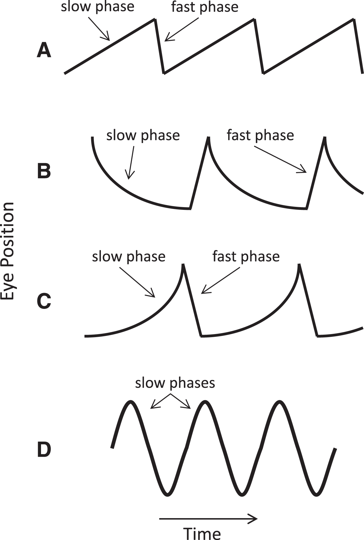 Common nystagmus slow-phase waveforms. (A) Constant velocity (linear) waveform, with added fast phases producing a sawtooth appearance characteristic of vestibular or cerebral hemispheric disease. (B) Decreasing velocity waveform with a negative exponential time course typical of pathologic gaze-evoked nystagmus from an impaired neural integrator. (C) Increasing velocity waveform suggesting an unstable neural integrator. (D) Pendular nystagmus, consisting of only slow phases. Adapted from Leigh and Zee [109].