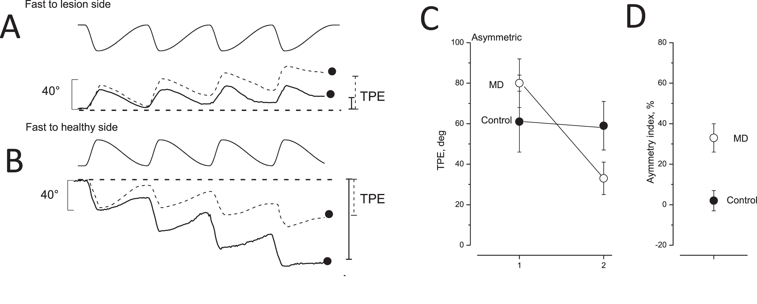 Tracking position error after opposite directed asymmetric rotation and asymmetric index in unaffected and MD patients. A,B: tracking of memorized visual target during asymmetric rotation. Upper trace: chair rotation; lower trace: tracking of memorized target of unaffected (dashed line) and MD patients with vestibular functional deficit (solid line). The filled circles and vertical bars indicate the final tracking position error (TPE) on the right (solid line: MD patients; dashed line: controls). In A, the fast rotation was directed toward the lesion side; in B, the fast rotation was toward the healthy side. C: TPE (mean and SD) of 28 unaffected (control, filled circles) and 28 MD patients (open circles) in response to asymmetric rotation. The TPE values induced by a fast half cycle to the healthy or irritated side (left side) were greater than those in response to a fast half cycle to the lesion or non-irritated side (right side). D: Perceptual asymmetric index (mean and SD) of control (filled circles) and MD patients (open circles) in response to asymmetric rotation.