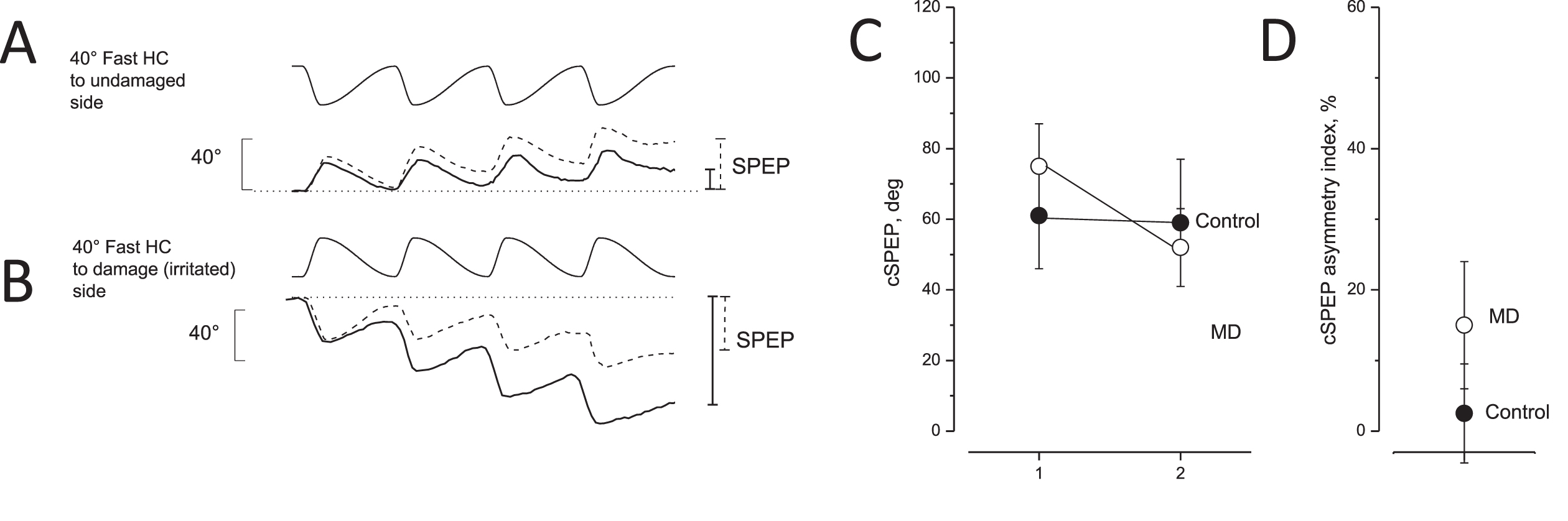 Eye movement recording during asymmetric rotation in response to opposite directed asymmetric rotation and asymmetric index in unaffected and MD patients. A, B: Slow phase eye position (SPEP) in response to opposite directed sequence of four cycles of asymmetric rotation with a fast half cycle toward the lesion side (A) and the healthy side (B). Upper traces: asymmetric rotation; and lower traces: SPEP (solid line: MD patients, dashed line: controls). Cumulative eye position at the end of rotation is indicated by vertical bars on the right (solid line: MD patients; dashed line: controls). Note that the cumulative SPEP of MD patients was smaller in A and greater in B compared with the controls. C: Cumulative SPEP (cSPEP) (mean and SD) of unaffected (control, filled circle) and MD patients (open circles) in response to opposite directed asymmetric rotation: fast half cycle to healthy or irritated side (left) versus fast half cycle to lesion or side not irritated (right). Note that controls did not show a different cumulative SPEP in contrast to MD patients. D: cSPEP asymmetry index in unaffected (control, filled circle) and in MD patients (open circles) in response to the opposite directed asymmetric rotation.