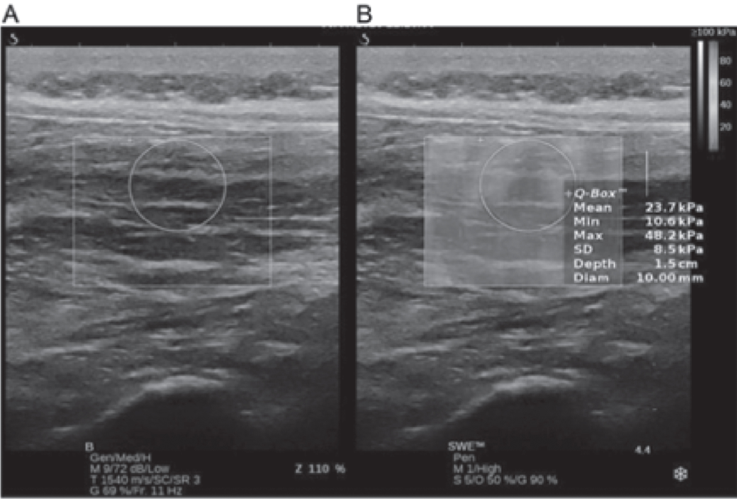 Measurement by shear wave elastography. A: B-Mode ultrasound. B: Overlays shear wave elastography to B-Mode ultrasound and measures Young’s modulus in the Q-Box™.