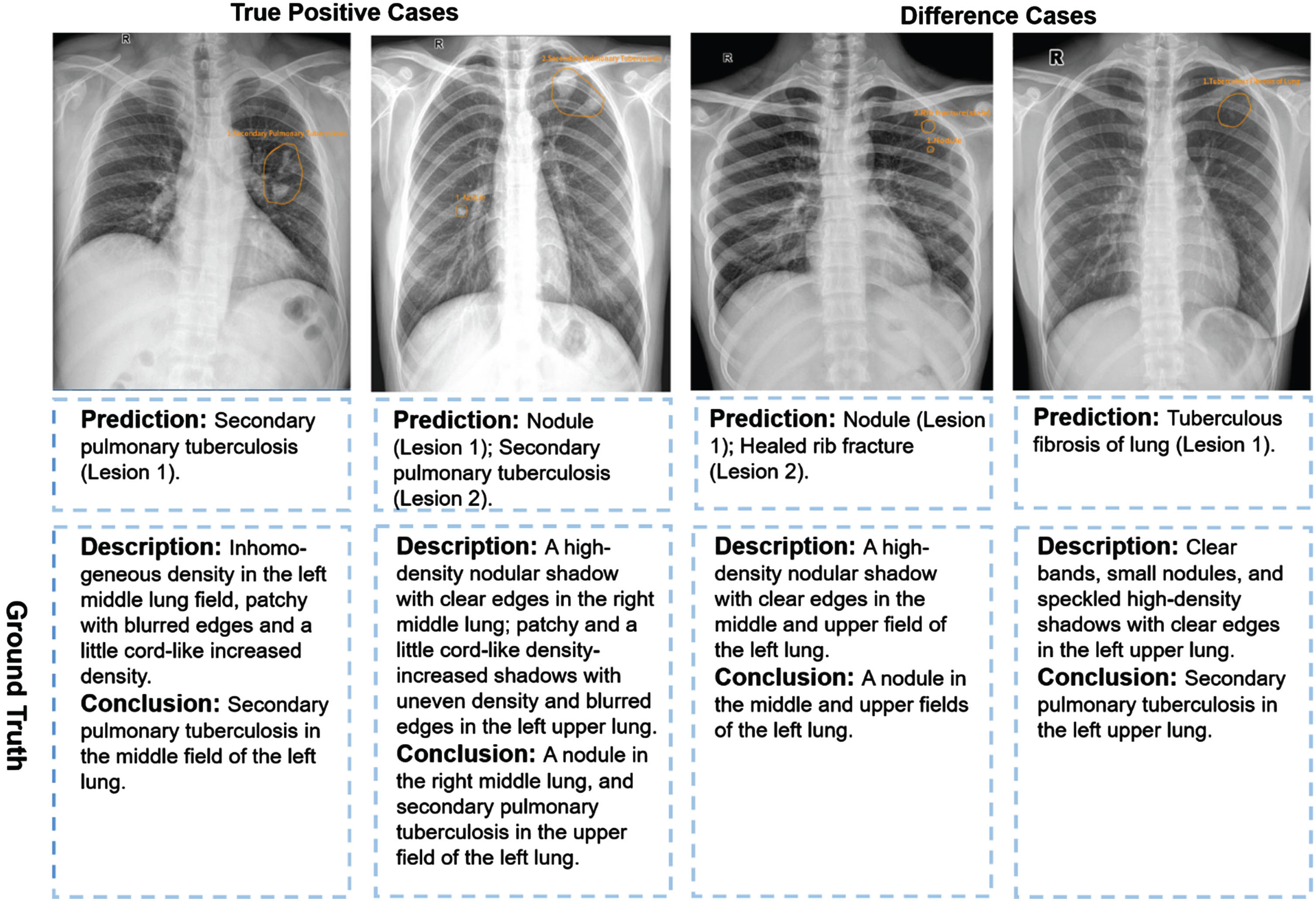 Examples of two true positive cases and two difference cases for the experiment group. Yellow outlines were annotated by the MOM-ClaSeg AI system.