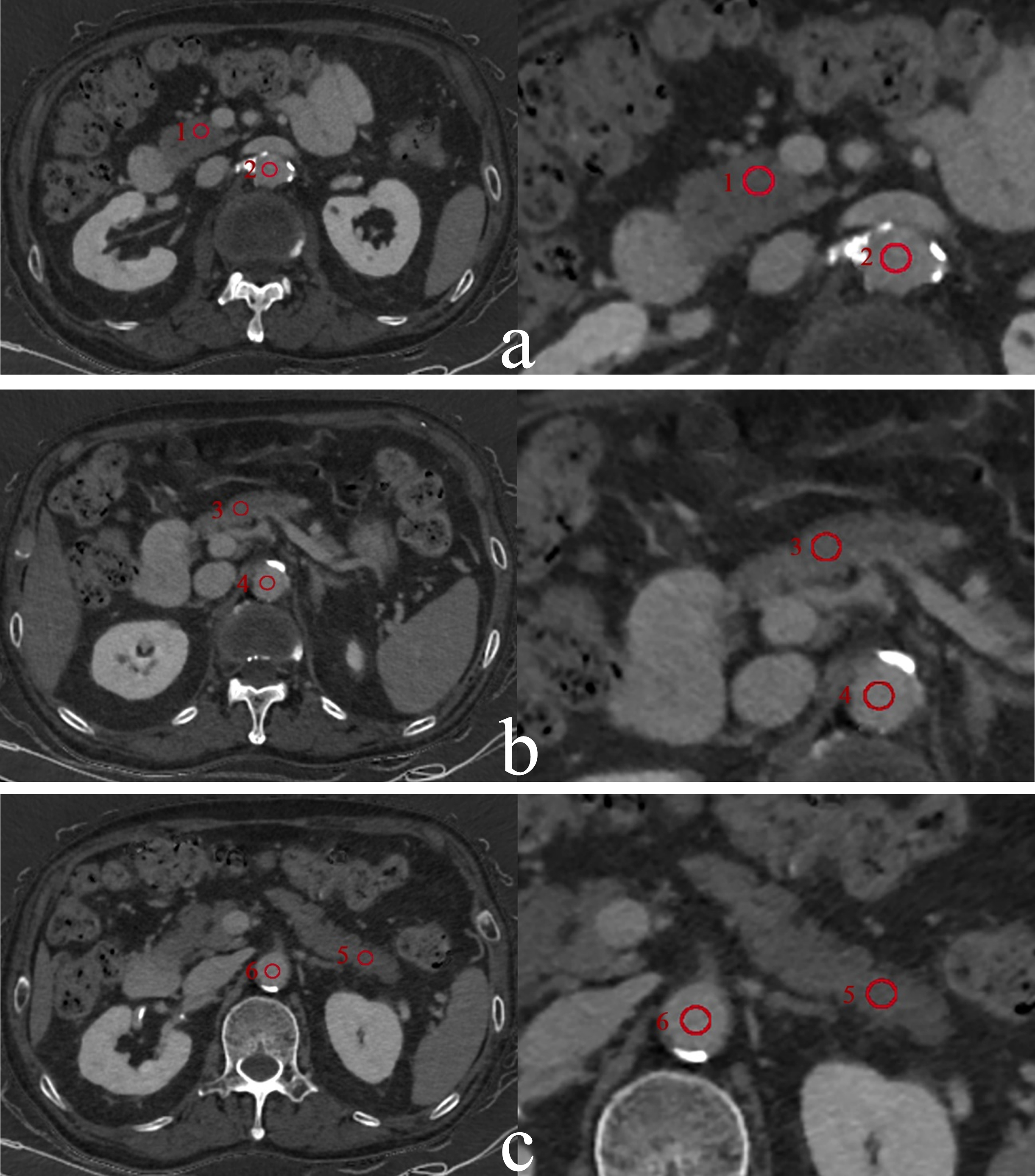 The measurement of ECVpancreas in a 75-year-old man with primary hypertension in Grade 1 hypertension group. Pancreatic iodine maps (iodine-water basic pair) were generated from spectral CT in equilibrium phase at the level of pancreatic head (a), body (b), and tail (c). Six red circles represent the ROIs placed in the head (1), body (3), tail (5), and abdominal aorta at the same level (2, 4, 6), respectively.