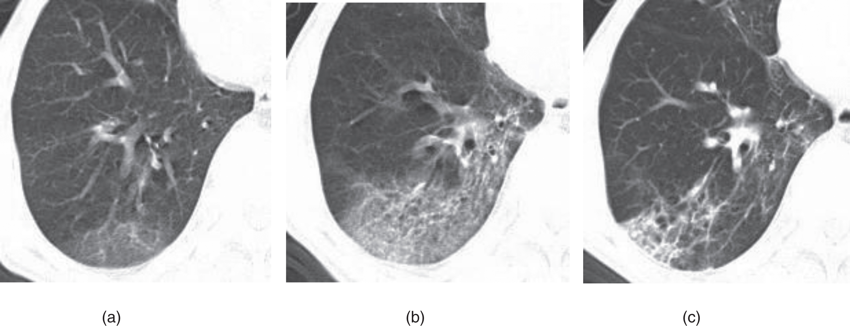 Example of CT image slices of a male COVID-19 patient of 65 years old. (a) CT scan performed 2 days after admission. Images show ground-glass opacity (GGO) in the posterior basal segment of the right lower lobe, with the lesion located subpleural region. (b) CT images obtained 10 days after admission. Lesions Increased with higher density and thickening of the interlobular septum. (c) Follow-up CT scan (obtained at day 36 after admission and 18 days after discharge) shows visible parenchymal bands, irregular interface, and traction bronchiectasis, which indicates fibrosis. The patient was enrolled in group A.