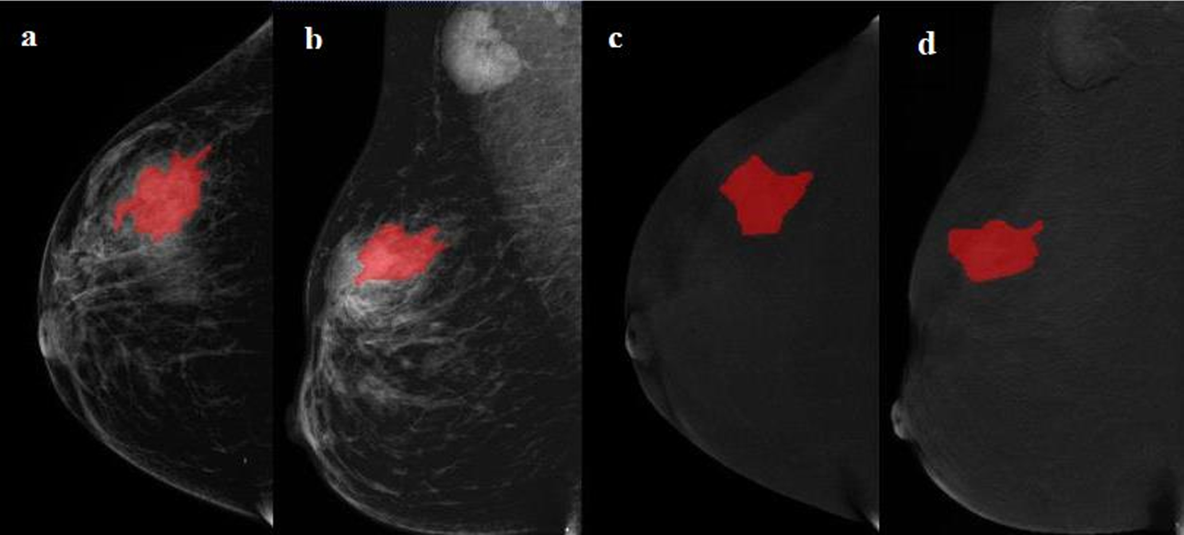 Examples of regions of interest (ROIs) segmentation on contrast-enhanced spectral mammography (CESM) images. (A, C) The low-energy and recombined images with cranial caudal (CC) view. (B, D) The low-energy and recombined images with mediolateral oblique (MLO) view. The ROIs of breast lesions were drawn manually on low-energy and recombined images, respectively.